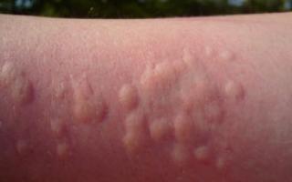 Кишечник и аллергия Добавки, способствующие сокращению респираторных симптомов аллергии